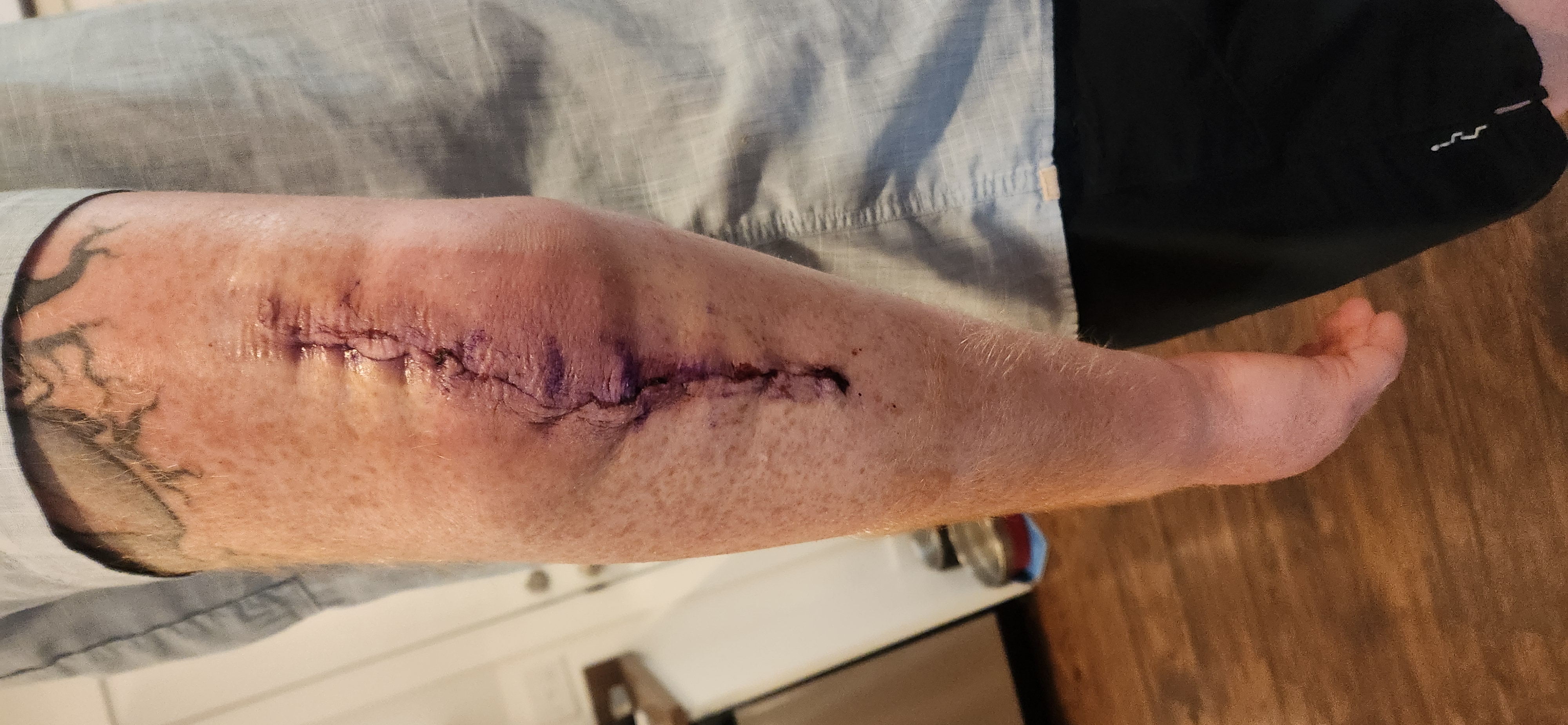 Two weeks after surgery